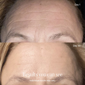 Close-up of a person's forehead comparing Day 1 wrinkles to smoother skin on Day 30 after using the Solawave 2x Wrinkle Retreat LED Face Mask. Text reads: "Results you can see. Individual results may vary.