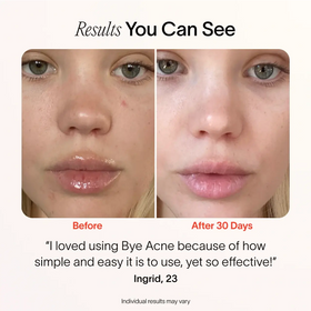 A close-up of a womans face depicts the before and after effects of SolaWaves Bye Acne: 3-Minute Pimple Spot Treatment. The left image shows breakouts, while the right reveals a clearer complexion. Caption reads: I loved using Bye Acne. before-after Ingrid, 23.  || Periwinkle