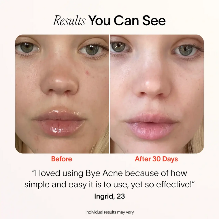 A close-up of a womans face depicts the before and after effects of SolaWaves Bye Acne: 3-Minute Pimple Spot Treatment. The left image shows breakouts, while the right reveals a clearer complexion. Caption reads: I loved using Bye Acne. before-after Ingrid, 23.  || Periwinkle