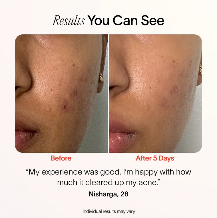 Split image shows a persons cheek before and after treatment. The Before side has visible breakouts, while the After 5 Days side shows clearer skin. Text: I’m happy with my experience using SolaWaves Bye Acne: 3-Minute Pimple Spot Treatment; it significantly cleared up my acne. before-after || Periwinkle